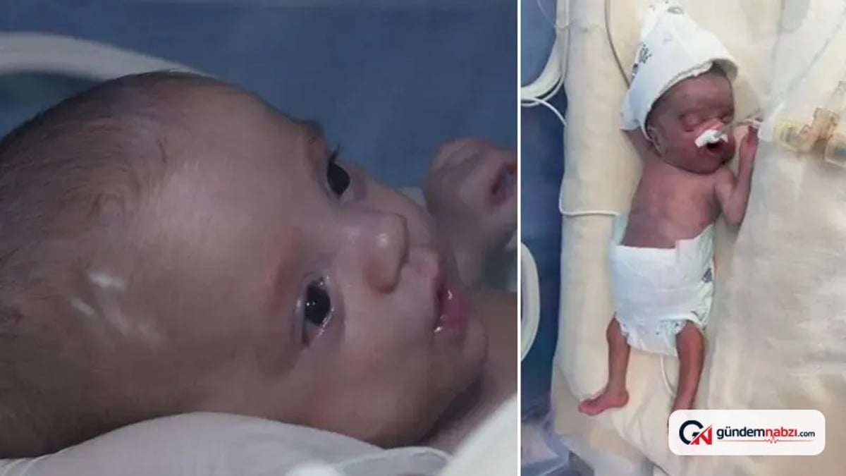 Doruk bebek, 5 aylık yaşam mücadelesini kazandı