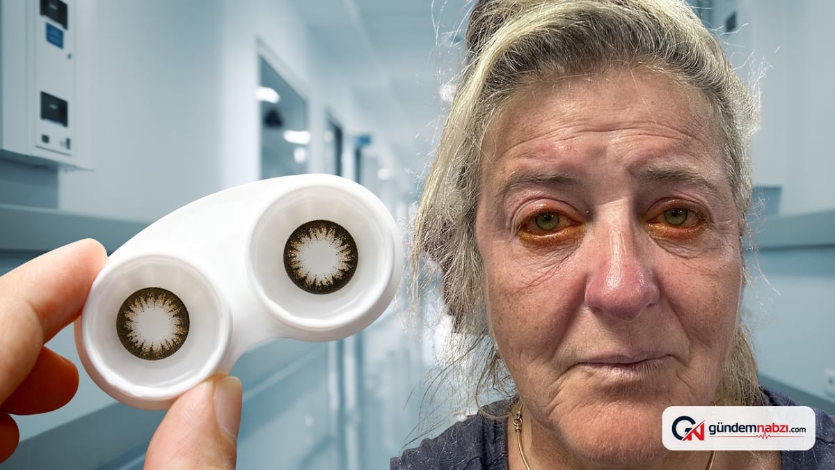Lenslerini takarken hijyeni unuttu, görme yetisini kaybetti