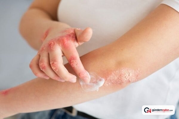 Antihistaminiklerin egzamayı hafifletmediği belirlendi