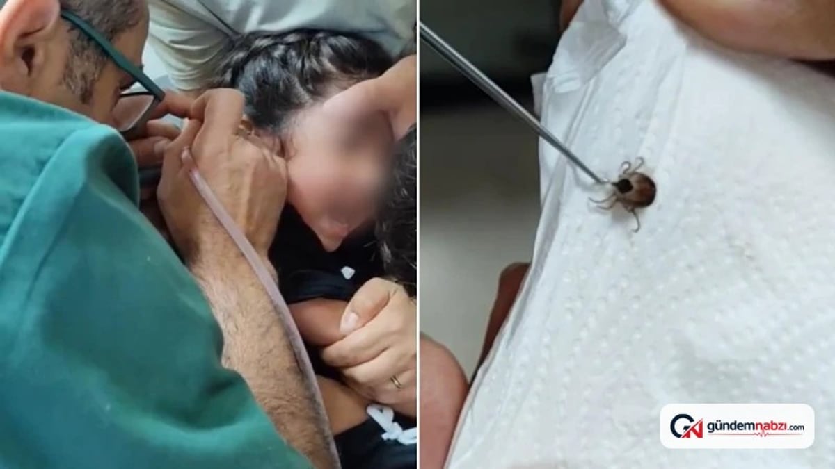 Eskişehir'de çocuğun kulağından canlı kene çıkarıldı