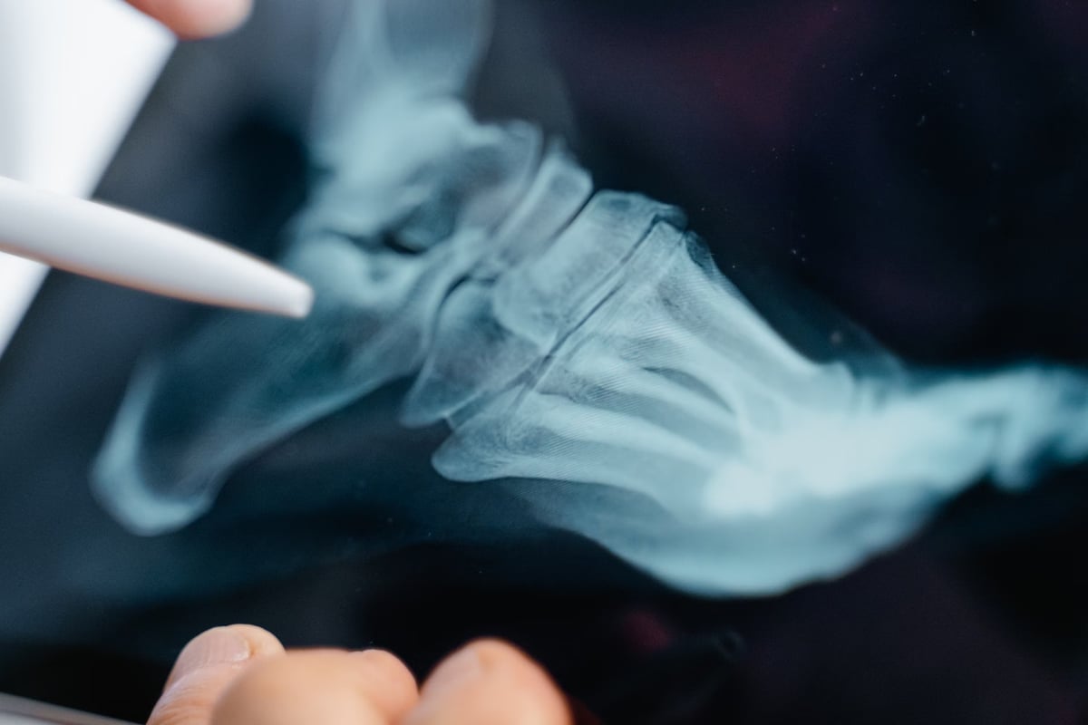 İleri yaşlarda osteoporoz riski artıyor
