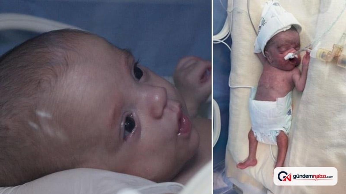 Doruk bebek, 5 aylık yaşam mücadelesini kazandı