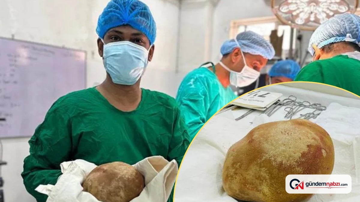 Sri Lanka'da hastanın mesanesinden 3,1 kilo ağırlığında taş çıkarıldı